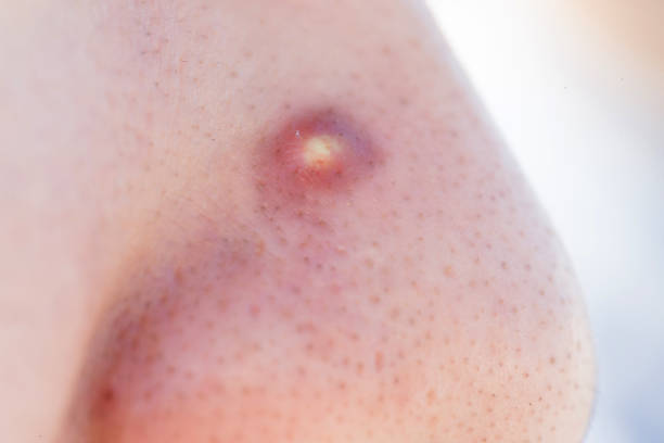 istock close up of facial acne 993438596