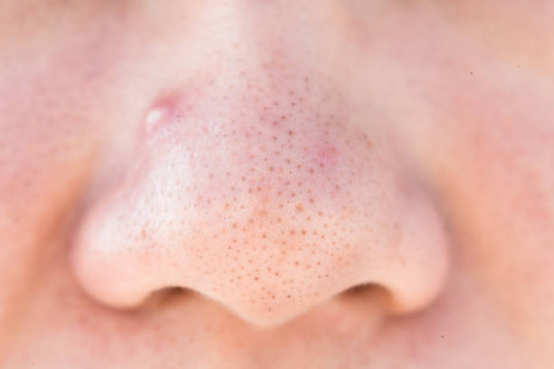 istock close up of black head 993439220