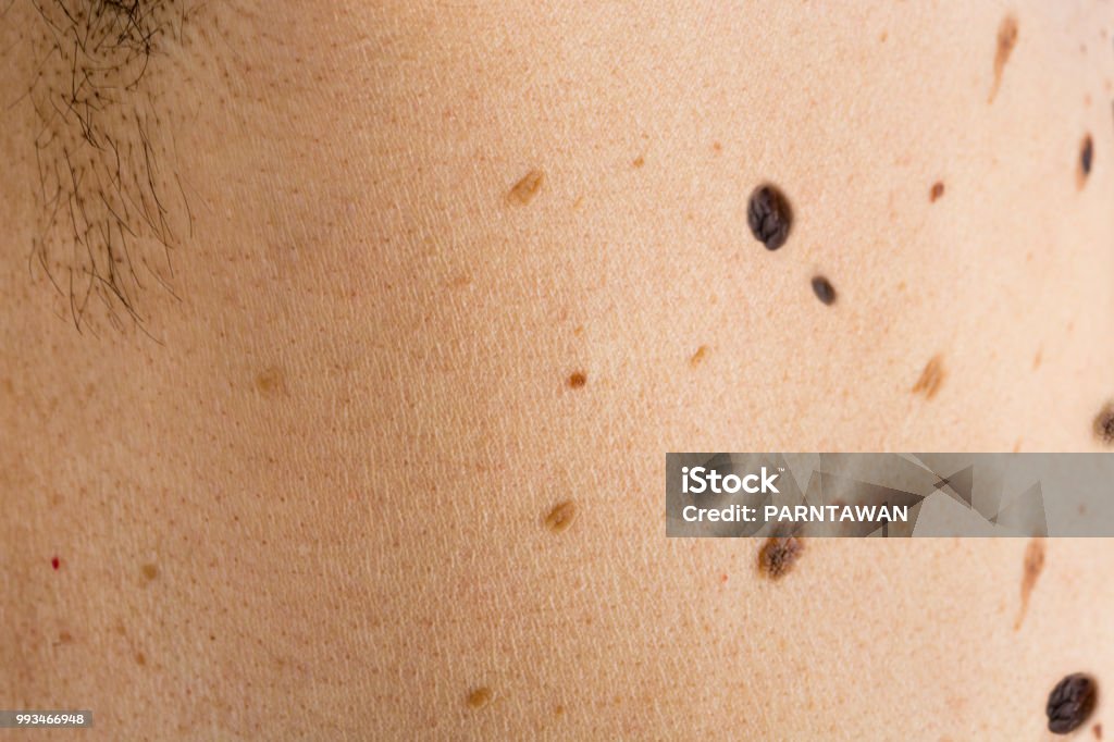 Detail of the bare skin on man in the back, Disorders of body with moles on skin growths include warts lot of wart, mole, birthmark, wart, gnarl, wart, Skin problems, Sun effect on skin. Acne Stock Photo
