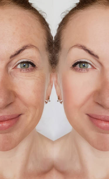 istock face girl wrinkle before and after cosmetic procedures 993618612