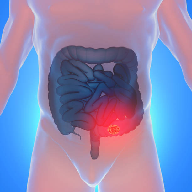 3d illustration of colorectal cancer in a human 3d illustration of colorectal cancer in a human rectum stock pictures, royalty-free photos & images
