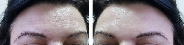 face woman forehead wrinkles before and after cosmetic procedures face woman forehead wrinkles before and after cosmetic procedures botox before and after stock pictures, royalty-free photos & images