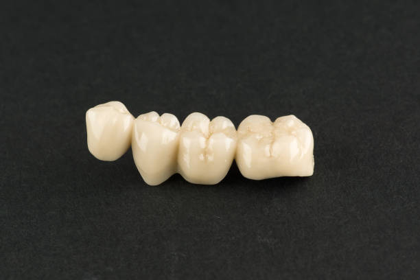 istock cermet dental bridges 994890834