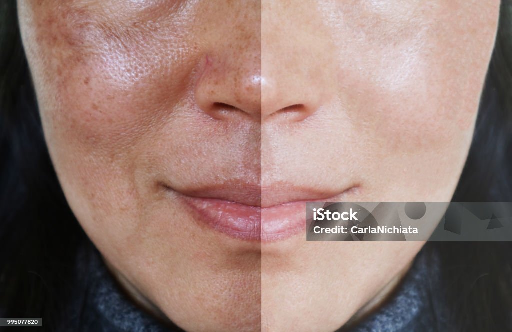 Cara con poros abiertos y melasma antes y después de hacer concepto de tratamiento. - Foto de stock de Piel - Partes del cuerpo libre de derechos