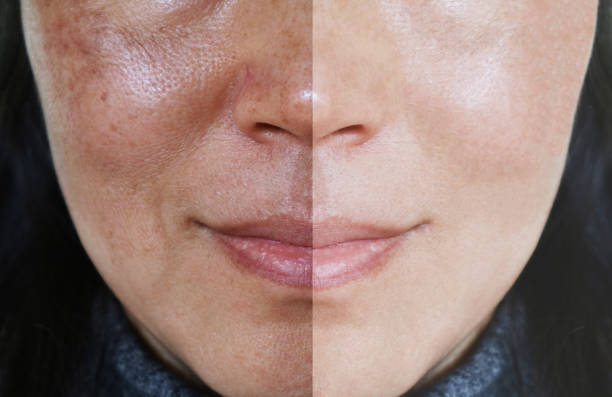 relever avec pores ouverts et mélasma avant et après le faire ou le concept de traitement. - face mask photos et images de collection