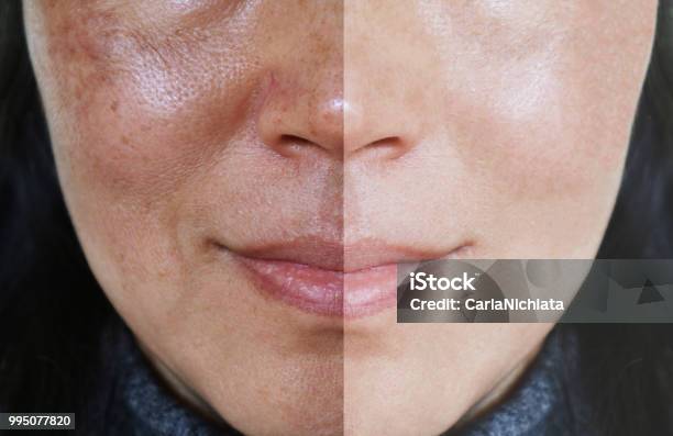 Face With Open Pores And Melasma Before And After Make Up Or Treatment Concept Stock Photo - Download Image Now