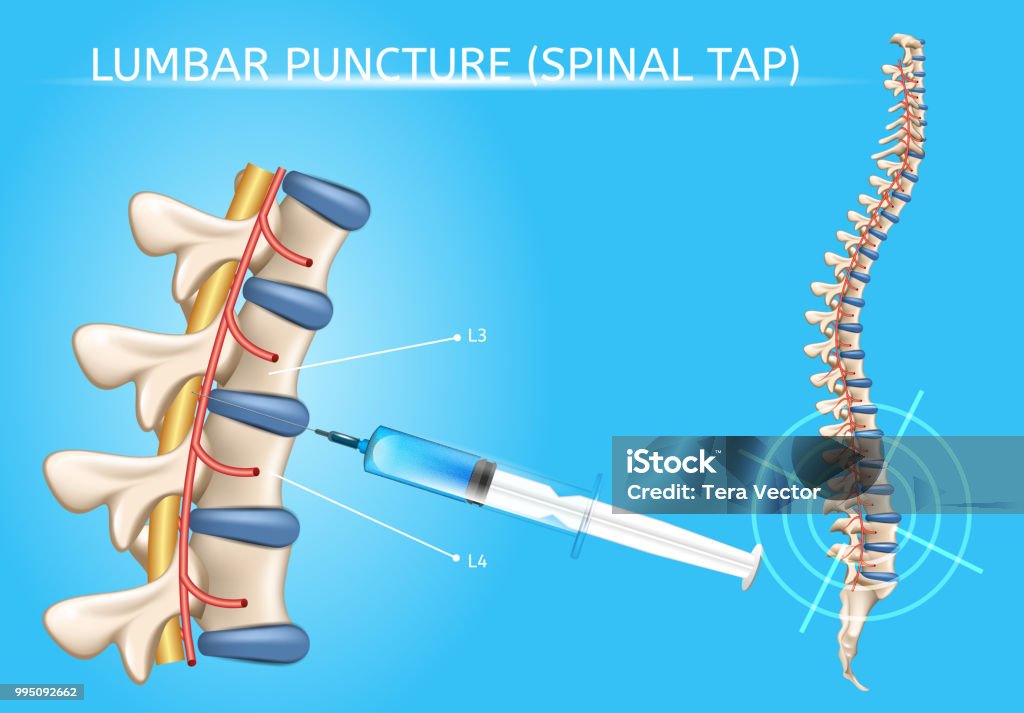 Ponction lombaire vecteur réaliste régime médical - clipart vectoriel de Crever libre de droits
