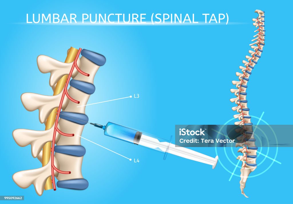 Lumbar Puncture Realistic Vector Medical Scheme Stock Illustration -  Download Image Now - Puncturing, Infographic, Syringe - iStock