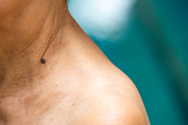 istock Black mole on senior woman's neck, Medicine, Close up 995446842