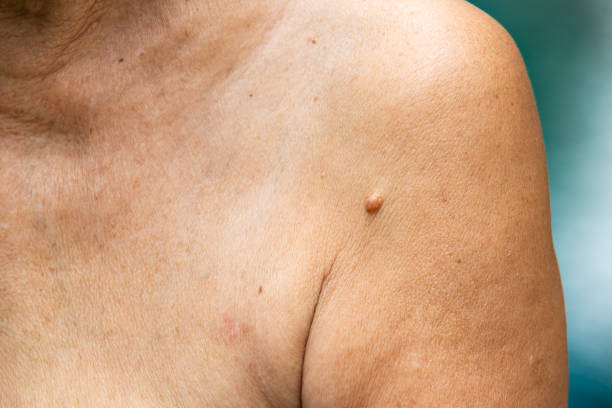 istock Brown mole on senior woman's  brachium, Medicine, Close up 995446982