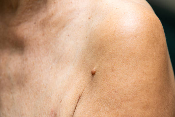 istock Brown mole on senior woman's  brachium, Medicine, Close up 995447094