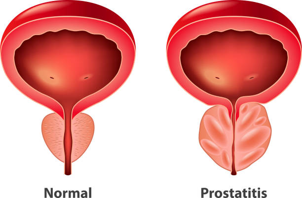 Vettore isolante della prostata normale e infiammato - illustrazione arte vettoriale