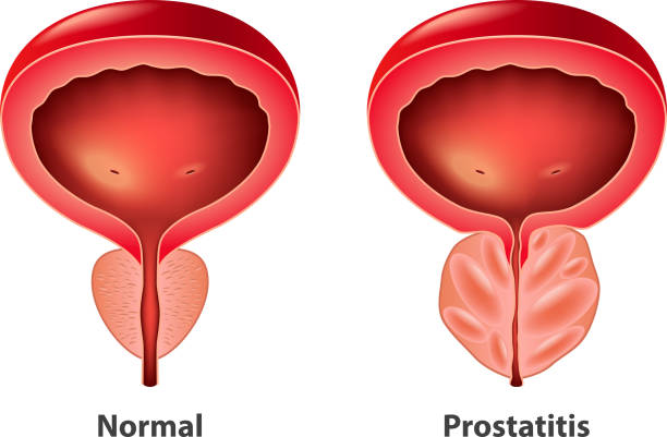 Prostatitis normal and inflamed prostate isolated vector Prostatitis normal and inflamed prostate isolated vector photo-realistic illustration large stock illustrations