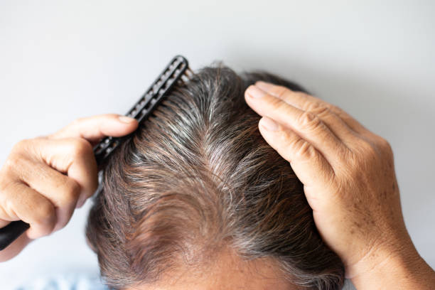 Closeup Hair grows on the head of an old woman stock photo