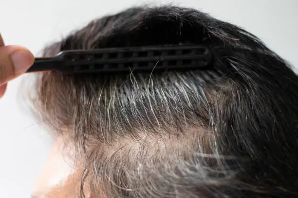 Photo of Closeup Hair grows on the head of an old woman