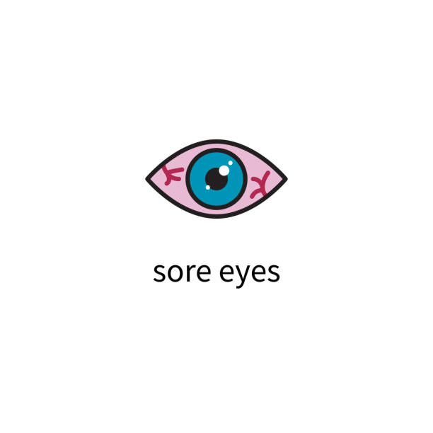ilustraciones, imágenes clip art, dibujos animados e iconos de stock de inflamación de ojo rojo - irritación