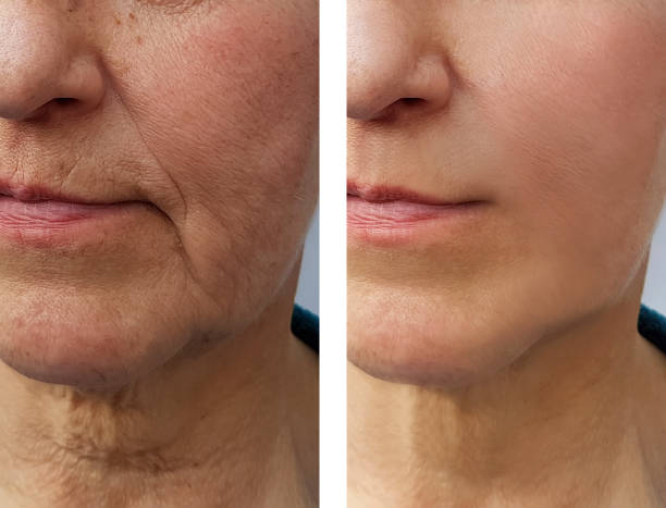 face   elderly woman wrinkles before and after face   elderly woman wrinkles before and after botox before and after stock pictures, royalty-free photos & images