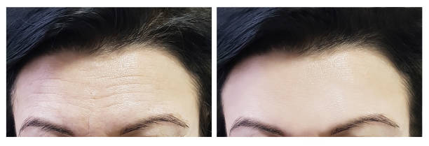 woman's forehead before and after procedures woman forehead before and after procedures botox before and after stock pictures, royalty-free photos & images
