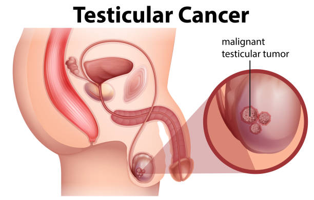 A Male Anatomy of Testicular Cancer vector art illustration