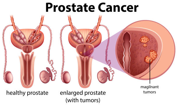 rak prostaty na białym tle - prostate cancer stock illustrations