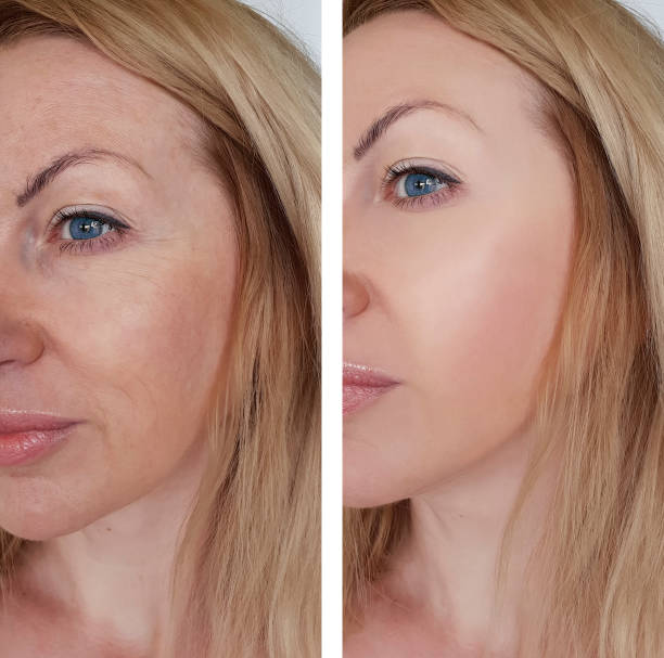 woman face wrinkles before and after procedures woman face wrinkles before and after procedures botox before and after stock pictures, royalty-free photos & images