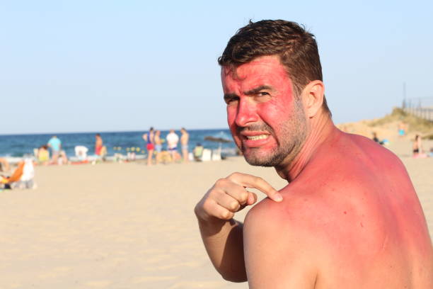 istock Man overexposing his skin to the sun 996793030
