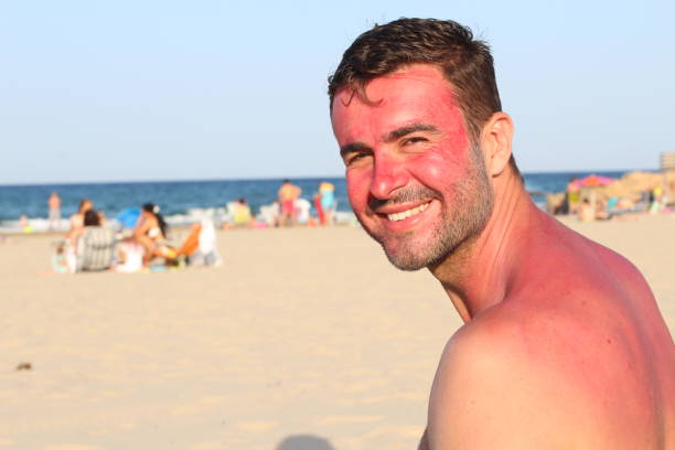 istock Man showing showing redness at the beach 996793428