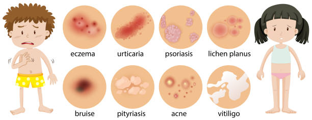 Autism And Rashes 2,400+ Rashes Illustrations Stock Illustrations, Royalty-Free Vector ...