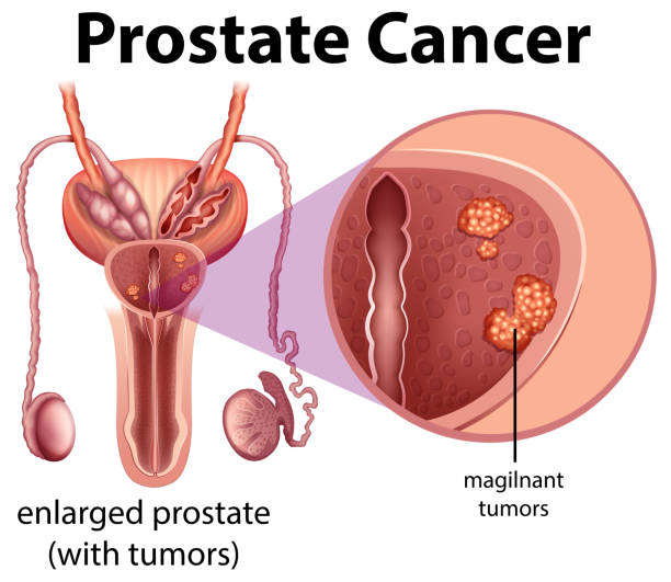 Male Prostate Cancer diagram Male Prostate Cancer diagram illustration phallic object stock illustrations