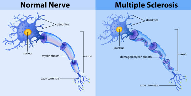 normál ideg- és szklerózis multiplex - myelin sheath témájú stock illusztrációk
