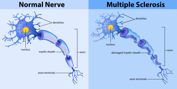 Normal nerve and multiple sclerosis vector art illustration