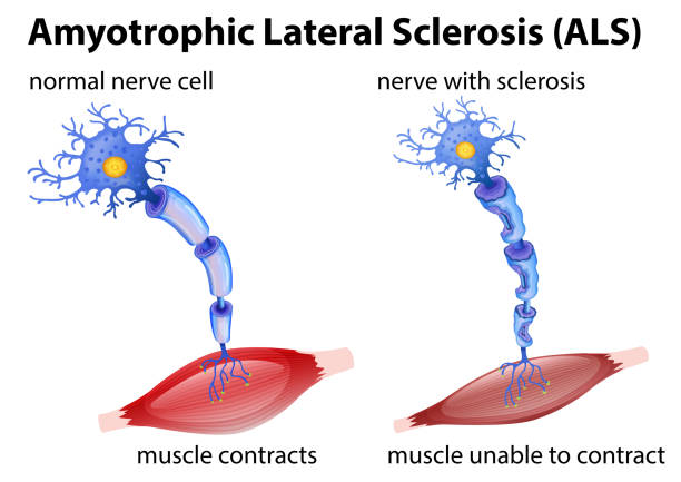Amyotrophic lateral sclerosis concept Amyotrophic lateral sclerosis concept illustration sclerosis stock illustrations