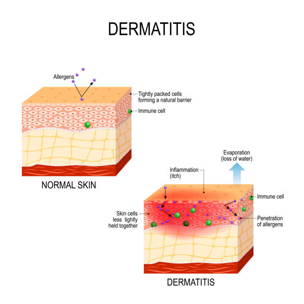 Atopic dermatitis (eczema) Atopic dermatitis (atopic eczema). Healthy skin and cross-section of human skin with dermatitis. showing changes and differences. Vector illustration for medical and educational use skin exame stock illustrations