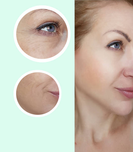 istock girl wrinkles face before and after 997568878