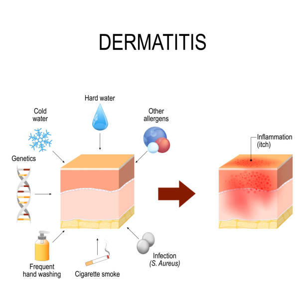 Atopic dermatitis (atopic eczema). factors that cause disease. c Atopic dermatitis (atopic eczema). Healthy skin, factors that cause disease, and cross-section of human skin with dermatitis. Vector illustration for medical and educational use skin inflammation stock illustrations