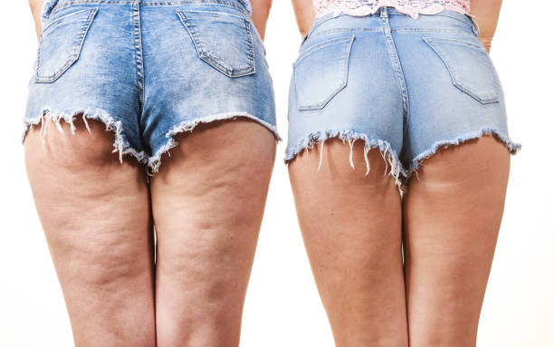 comparison of legs with and without cellulite - women human leg body buttocks imagens e fotografias de stock