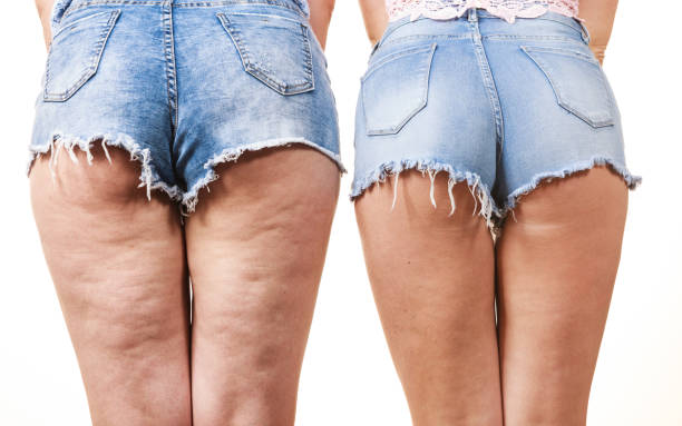 сравнение ног с целлюлитом и без него - buttocks human leg women body стоковые фото и изображения