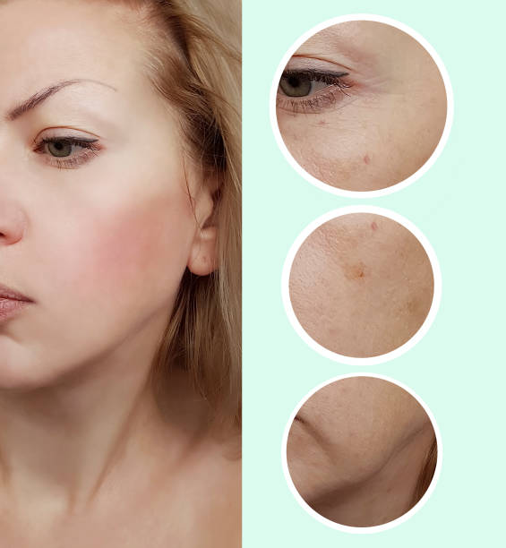 istock girl wrinkles face before and after procedures 997625472