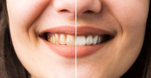istock Woman smile before and after bleaching 997657372