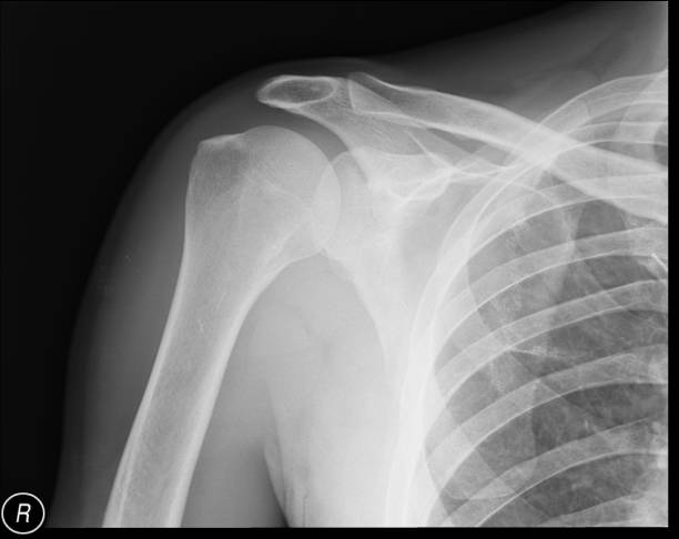 Right shoulder x-ray. Anteroposterior. No pathologic changes in bone structures. Right shoulder radiograph, AP (anteroposterior) view. No visible pathologic changes in bone structures, and no calcification in the rotator cuff. There are visible effects of the pleurectomy. scapula stock pictures, royalty-free photos & images