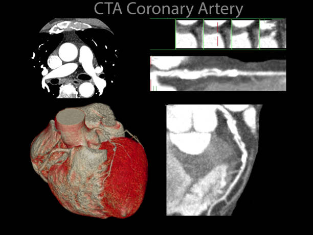 istock Multi view of CTA Coronary artery 2D and 3D rendering. 997790768