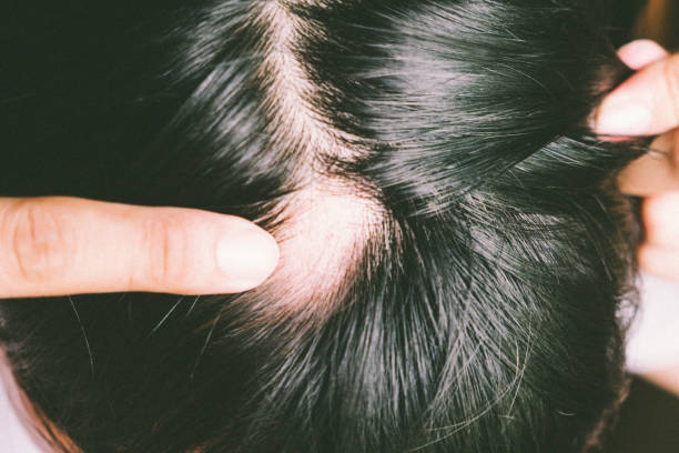 mann mit alopecia areata auf kopf, ort glatze, haare fallen problem - alopezie stock-fotos und bilder