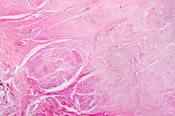 Light micrograph of scar tissue stock photo