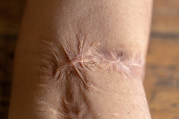 Scar on skin arm. Scar on skin arm. atrophy stock pictures, royalty-free photos & images