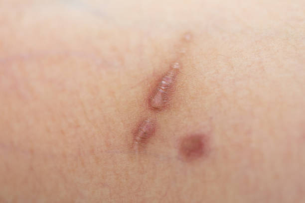 istock Scar on skin arm. 998454324