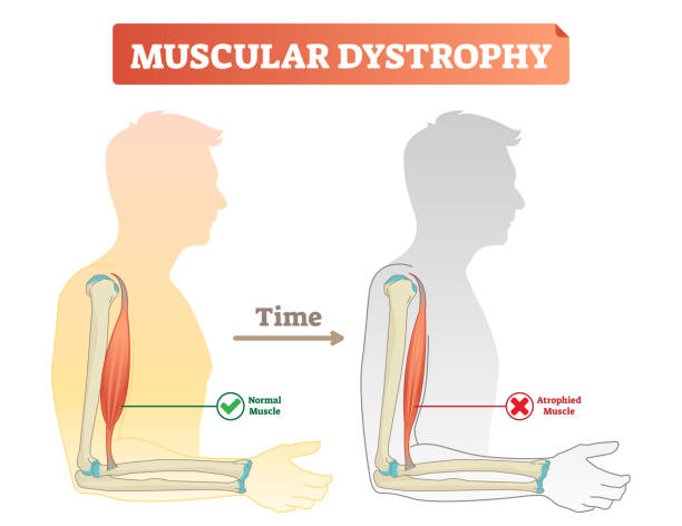 Vector illustration about muscular dystrophy. Compared normal muscle and atrophied muscle. Medical scheme how time affects health - healthy and weak human. Muscular dystrophy vector illustration. Compared normal and healthy muscle versus atrophied and weak. Medical scheme with explanation how time affects bicep - normal strong muscle and degeneration. myosin stock illustrations