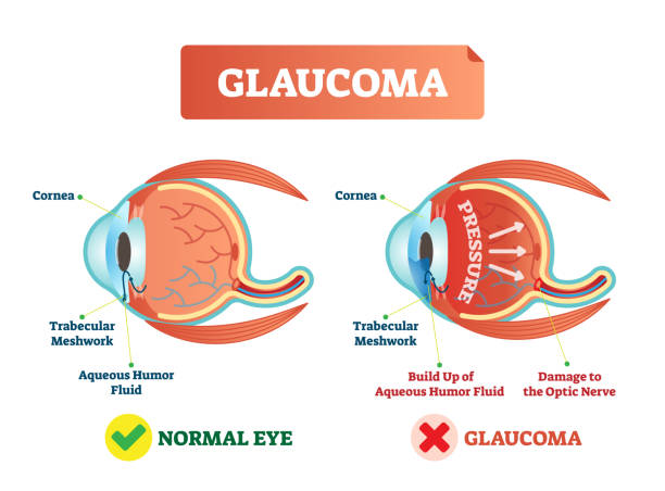 istock Vector illustration of glaucoma illness. Cross section comparement with normal and damaged eye. Scheme with cornea, trabecular meshwork and aqueous humor fluid. 998992914