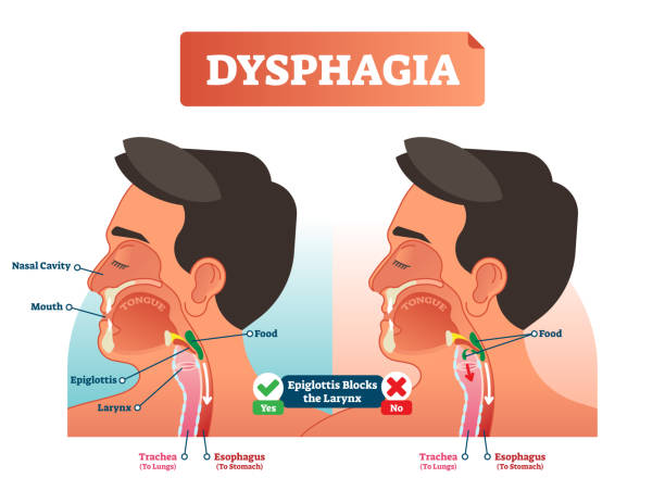 illustrazioni stock, clip art, cartoni animati e icone di tendenza di illustrazione vettoriale sulla disfagia e la comperò nello schema. primo uomo con cavità nasale, bocca, lingua, epiglottide, laringe, cibo, trachea ed esofago. - dysphagia