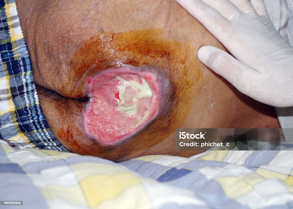 Ulcera da pressione - Foto stock royalty-free di Assistente domiciliare