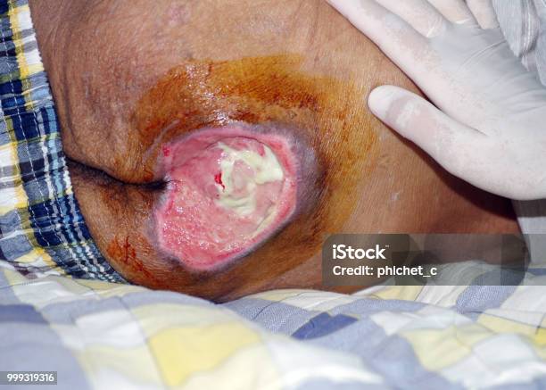 Pressure Ulcer Stock Photo - Download Image Now - Home Caregiver, Danger, Nurse